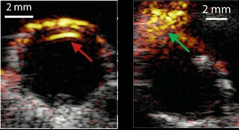 Photoacoustic imaging of the carotid artery with a health artery (red arrow, left) and one with plaque (green arrow, right). Image: Jan-Willem Muller