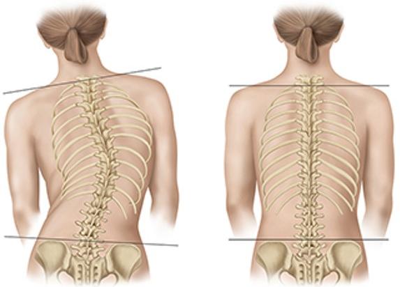 Scoliotic spine (left) and normal spine (right) (image: University of Iowa Health Care)