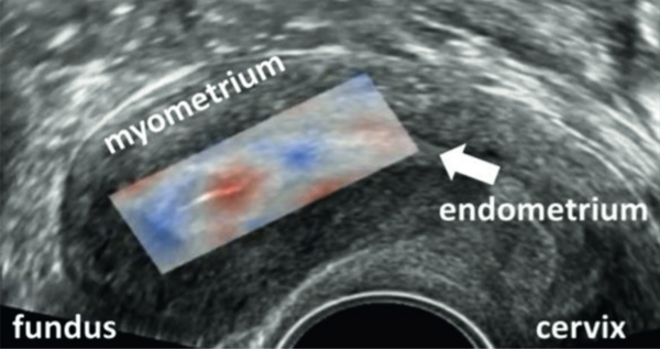 Op deze afbeelding is duidelijk de samentrekking (rood) en ontspanning (blauw) te zien van de baarmoeder. 
