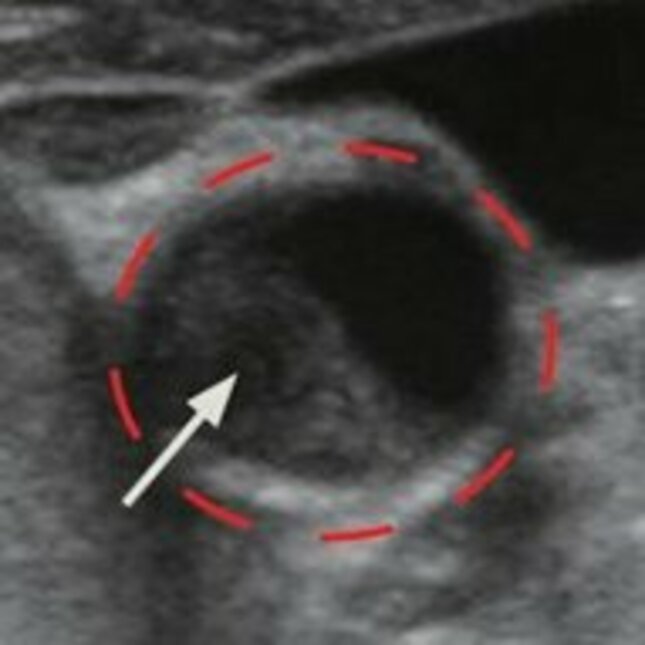A transverse ultrasound scan of the plaque at the distal common carotid artery. Image: Whal Lee/ Journal of Ultrasonography (https://www.e-ultrasonography.org/journal/view.php?doi=10.14366/usg.13018)